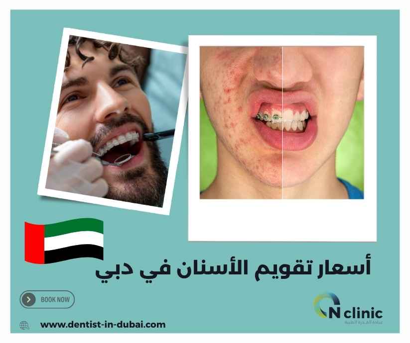 أسعار تقويم الأسنان في دبي
