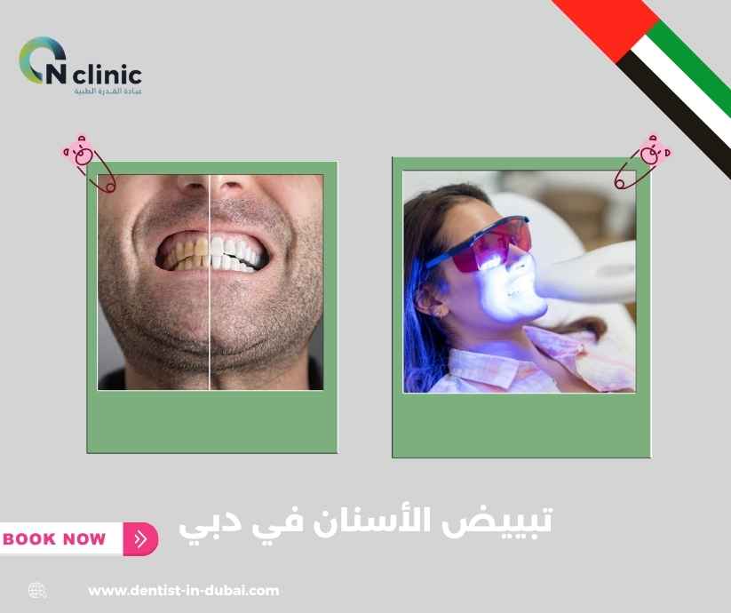 تبييض الأسنان في دبي