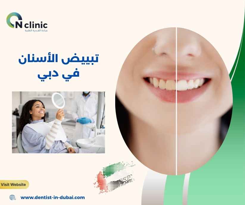 تبييض الأسنان في دبي