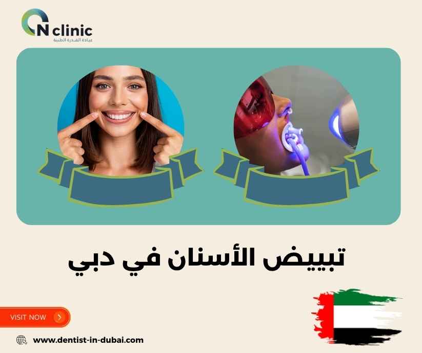 تبييض الأسنان في دبي
