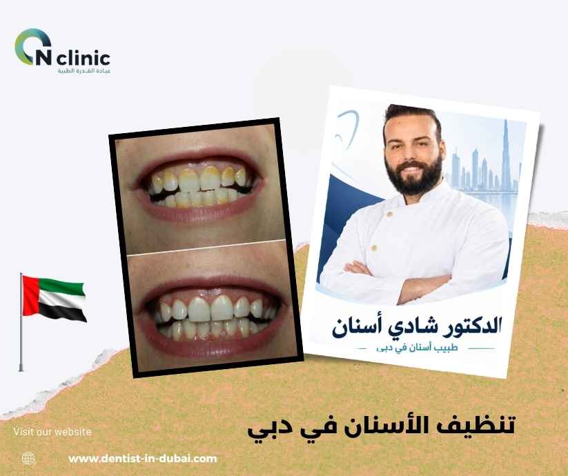 تنظيف الأسنان في دبي
