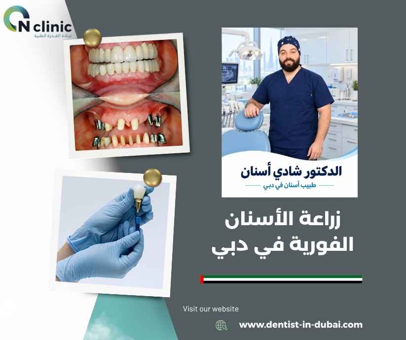 زراعة الأسنان الفورية في دبي