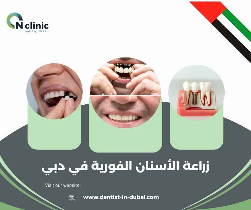 زراعة الأسنان الفورية في دبي
