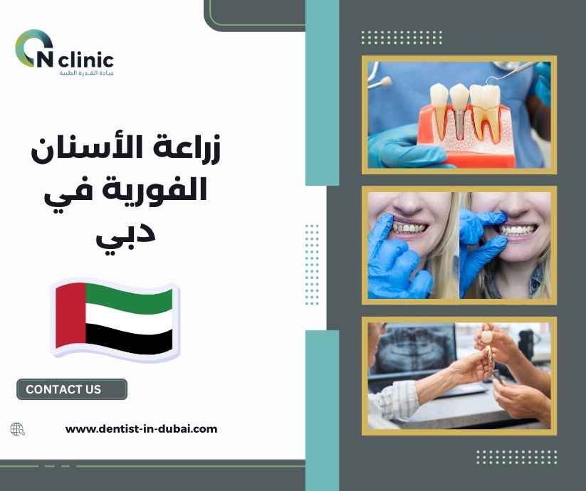 زراعة الأسنان الفورية في دبي