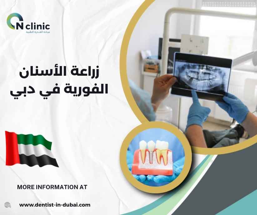 زراعة الأسنان الفورية في دبي