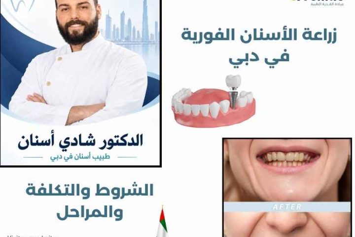 زراعة الأسنان الفورية في دبي