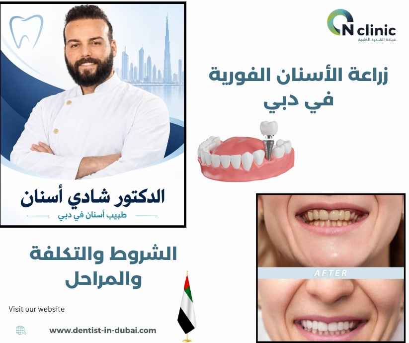زراعة الأسنان الفورية في دبي