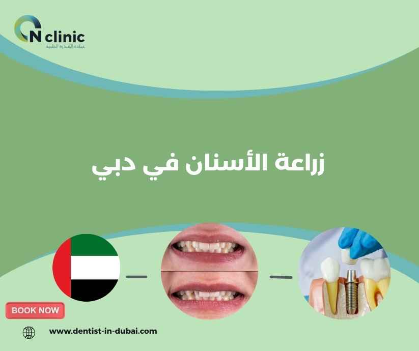 زراعة الأسنان في دبي 