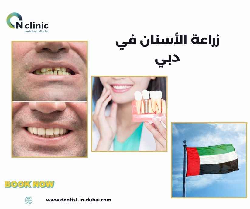 زراعة الأسنان في دبي 