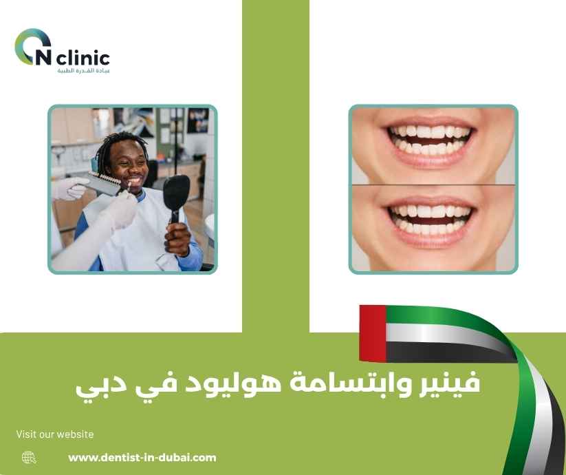 فينير وابتسامة هوليود في دبي