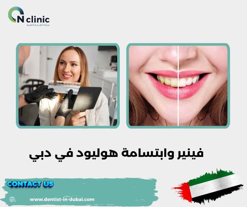 فينير وابتسامة هوليود في دبي