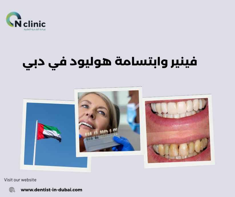 فينير وابتسامة هوليود في دبي